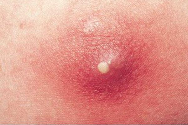 Mụn mủ trông như thế nào? 1