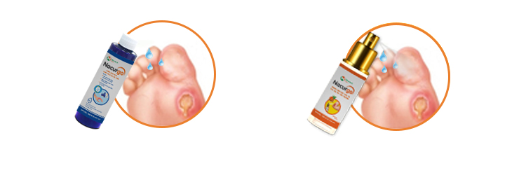 Bước 2: Chăm sóc và xử lý vết loét da tiểu đường 1