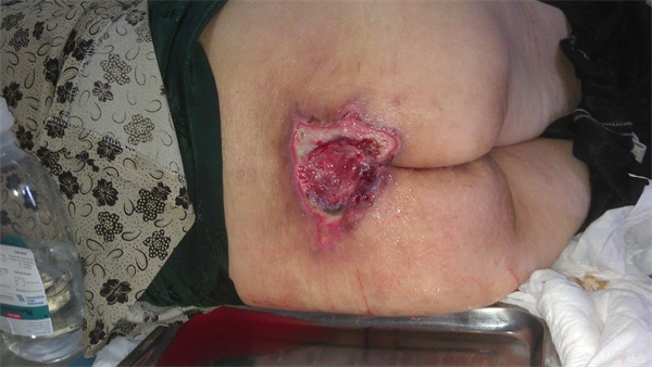 6 nguyên nhân và cách điều trị bệnh loét da ở người già 1