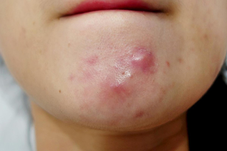 Hướng dẫn cách xử lí mụn bọc tại nhà từ a đến z 1