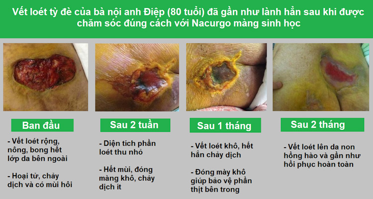 Bà nội nằm liệt lở loét da: cháu đích tôn giúp lành bằng cách khó tin! 6