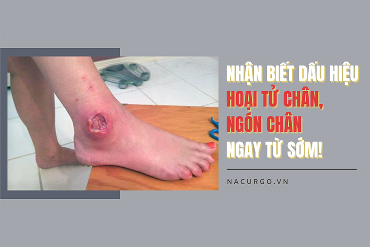 Tổng quan về hoại tử ngón chân và cách điều trị hiệu quả