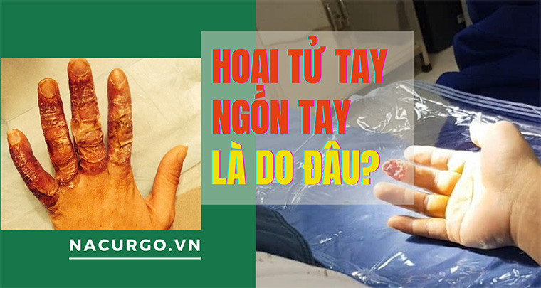 Dấu hiệu hoại tử ngón tay là gì và làm thế nào để điều trị?