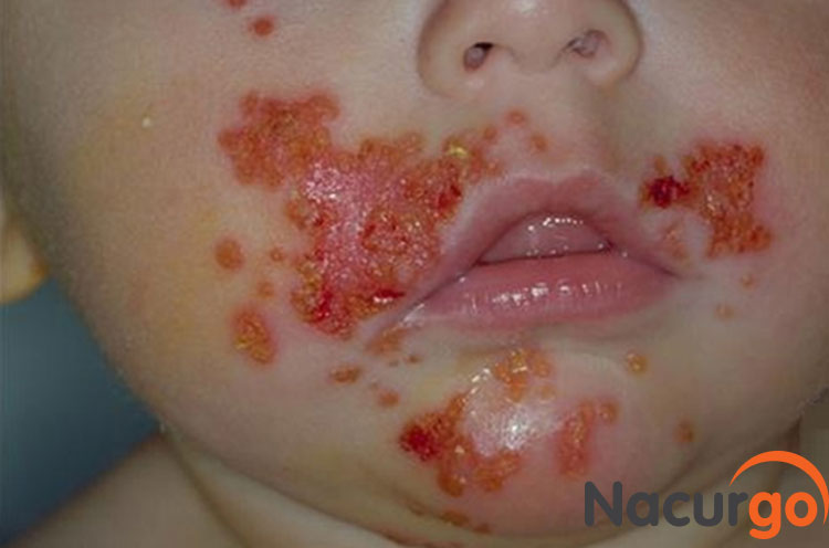 Triệu chứng lở loét da ở trẻ em 1