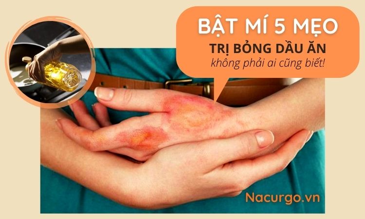 5 mẹo trị bỏng dầu ăn, mỡ tại nhà không để lại sẹo!