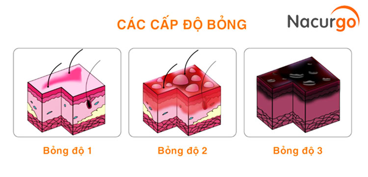 cap-do-bong-nuoc-soi