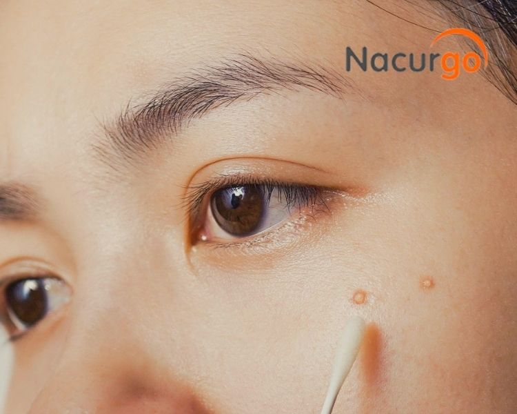 Cách sử dụng dung dịch Nacurgo màng sinh học trị bỏng do tỏi 1