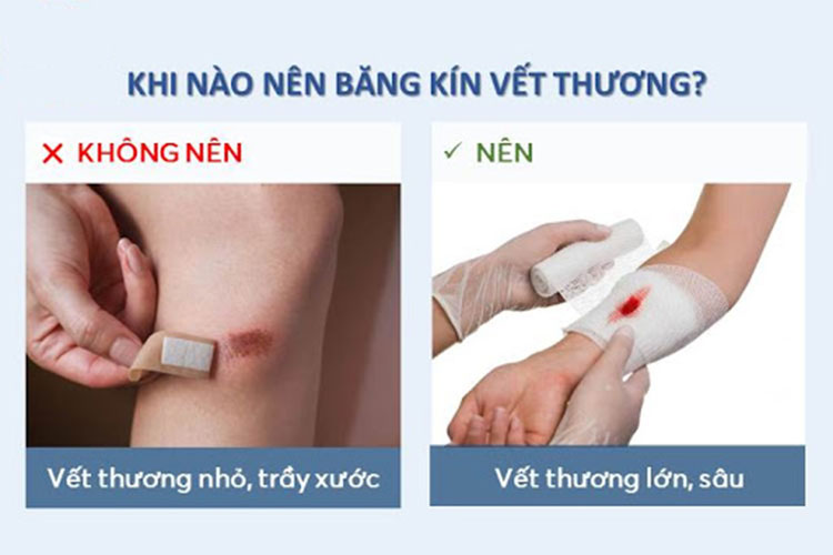 Vết thương hở nên để hở hay băng kín? 1