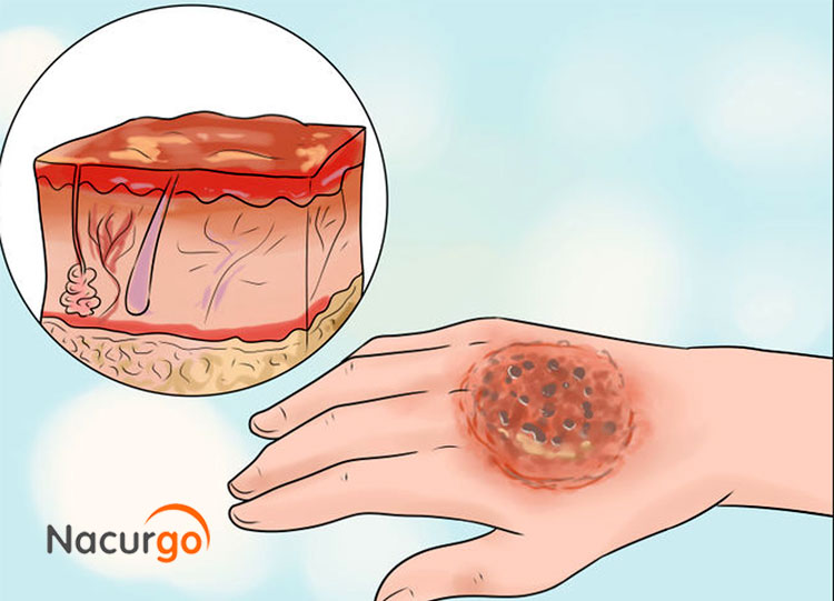 Đánh giá tình trạng bỏng để xử lý kịp thời 1