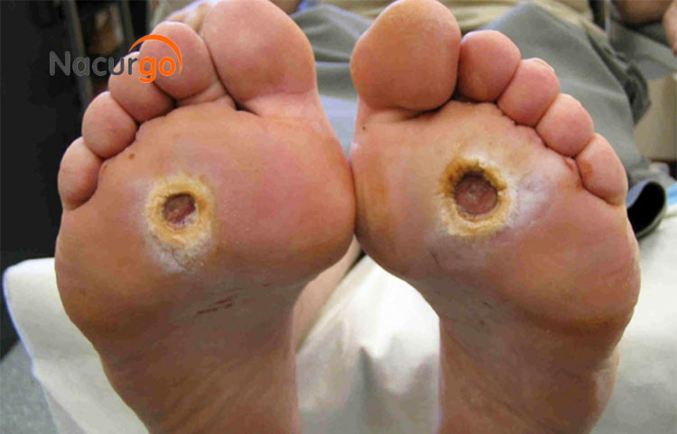 Nguyên nhân nào gây nhiễm trùng chân, bàn chân? 1