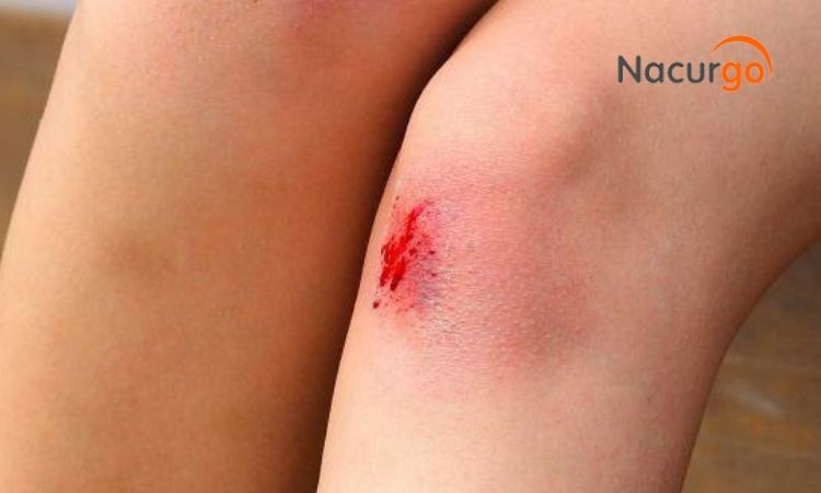 Trầy xước da chân tay - tình trạng thường gặp xử lý ra sao?