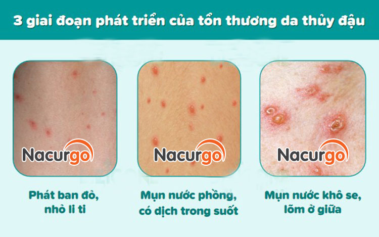 Bỏng dạ triệu chứng nhận biết ở trẻ nhỏ