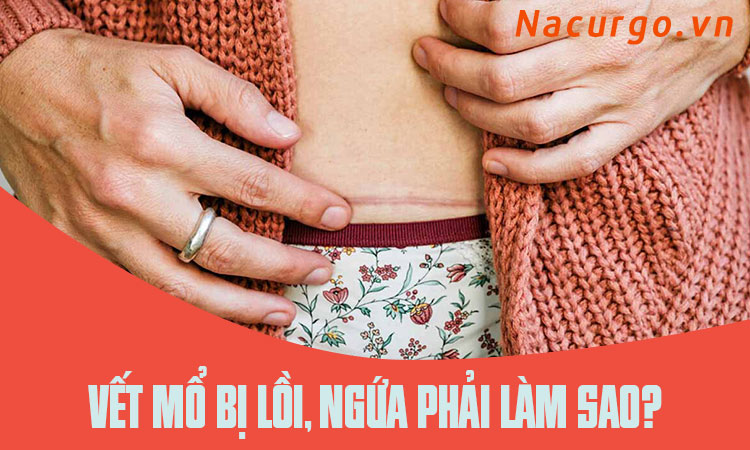 Có cách nào để phòng ngừa tình trạng vết mổ sau sinh bị ngứa sau 3 tháng không?
