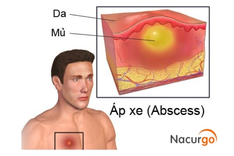 Đặc điểm cần chú ý của vết thương áp xe 1