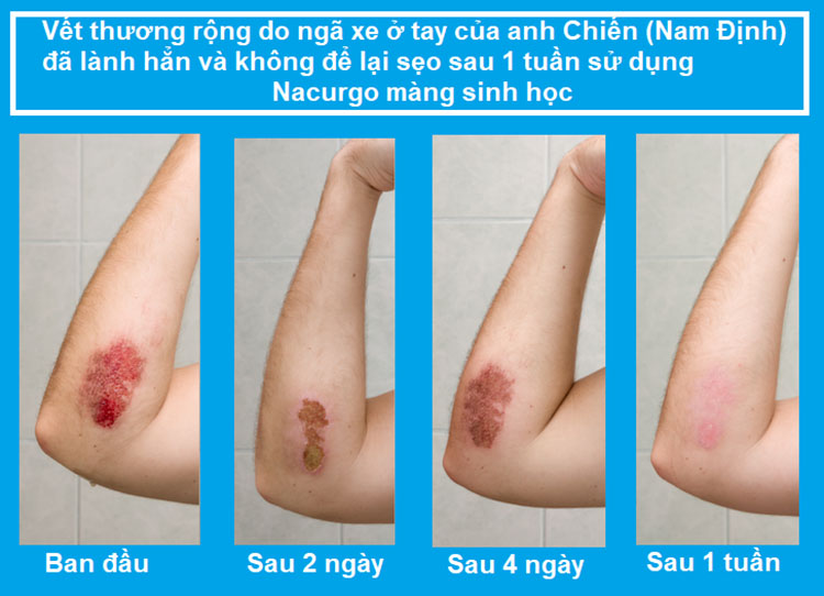 Khách hàng Anh Chiến sử dụng Nacurgo màng sinh học