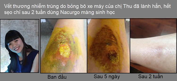 Khách hàng Chị Thu sử dụng Nacurgo màng sinh học