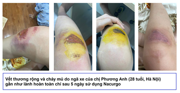 Khách hàng Chị Phương Anh sử dụng Nacurgo màng sinh học