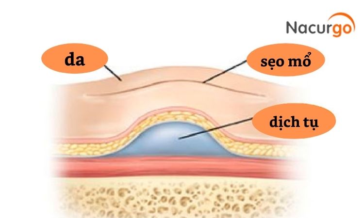 Làm Thế Nào Để Hết Dịch Vết Mổ: Nguyên Nhân và Cách Điều Trị Hiệu Quả