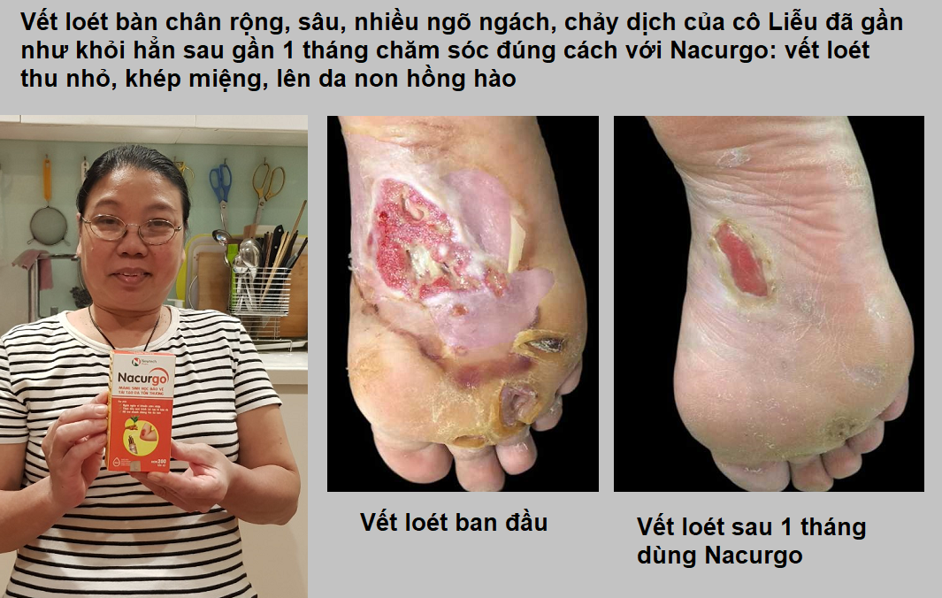 “Từ chia sẻ trên mạng của vị bác sĩ nổi tiếng, tôi đã lành hoàn toàn lở loét da tiểu đường!” 3 “Từ chia sẻ trên mạng của vị bác sĩ nổi tiếng, tôi đã lành hoàn toàn lở loét da tiểu đường!” 3