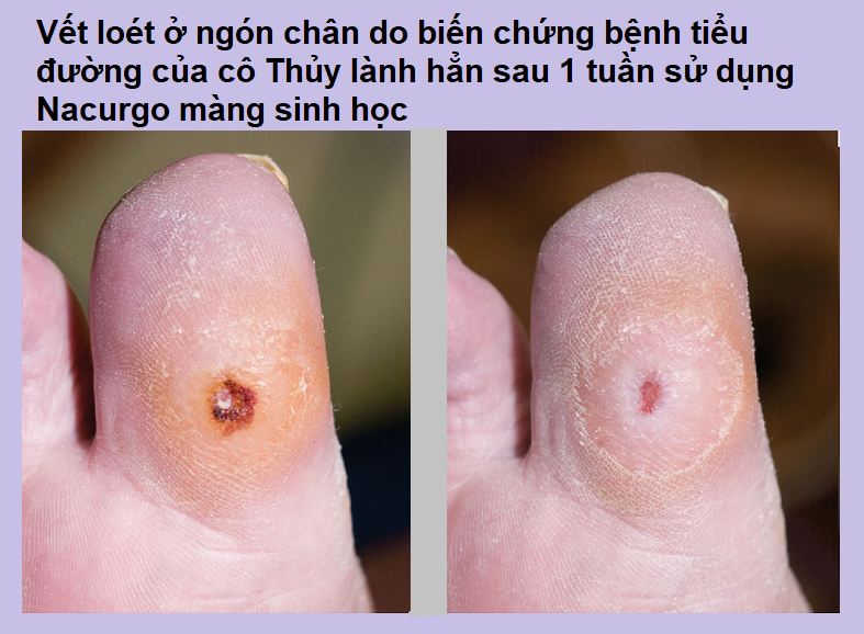 90% bệnh nhân dùng Nacurgo cho tình trạng lở loét da, loét tỳ đè cho phản hồi rất tốt 6 90% bệnh nhân dùng Nacurgo cho tình trạng lở loét da, loét tỳ đè cho phản hồi rất tốt 6