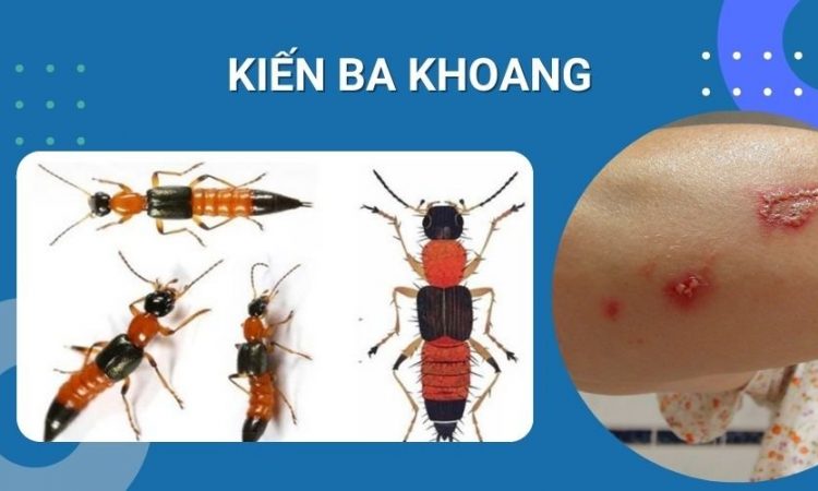 Dù già hay trẻ bị kiến ba khoang cắn cũng lành hoàn toàn chỉ sau 3 ngày! 1