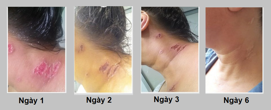 90% bệnh nhân hài lòng khi sử dụng bộ sản phẩm Nacurgo trong quá trình điều trị tình trạng Zona thần kinh (Giời 2