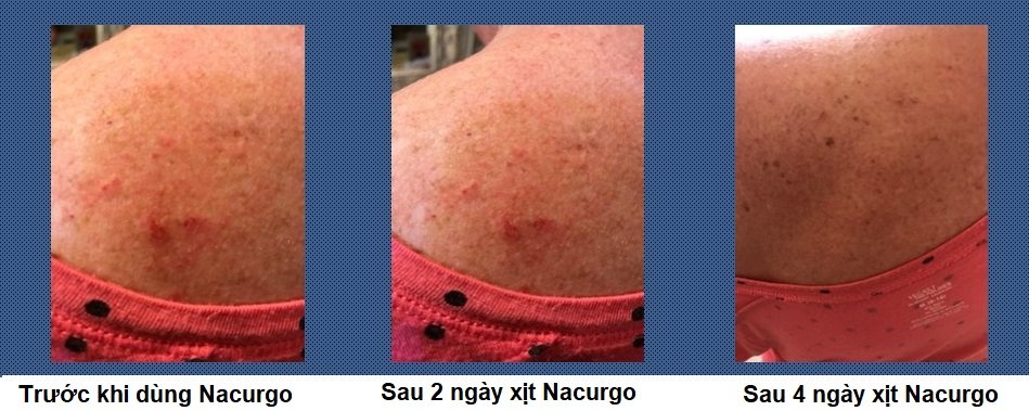 90% bệnh nhân hài lòng khi sử dụng bộ sản phẩm Nacurgo trong quá trình điều trị tình trạng Zona thần kinh (Giời 1