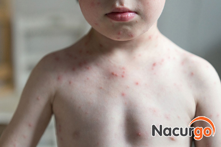 Trẻ em chưa tiêm phòng vắc xin thủy đậu là đối tượng có nguy cơ cao