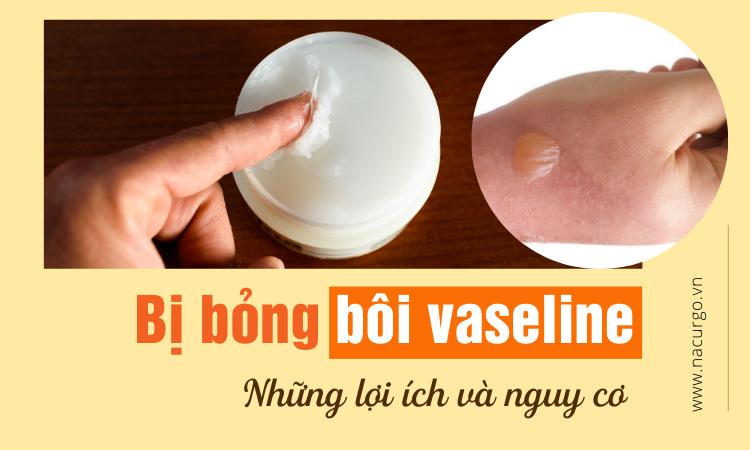 Bị bỏng bôi vaseline