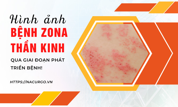 Hình ảnh bệnh zona thần kinh qua các giai đoạn phát triển bệnh!