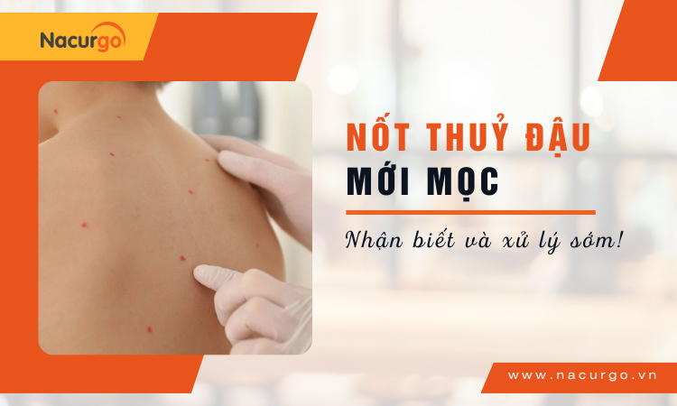 Vết thủy đậu mới mọc cách nhận biết và xử lý